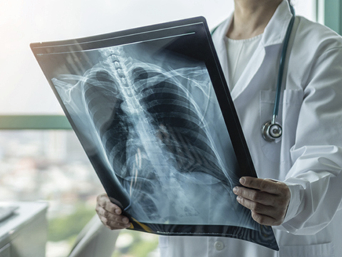 chronic broncho pneumo 2 480