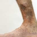 venous ulcer 130
