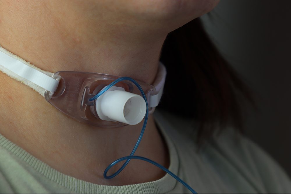 Tracheostomy tube in neck