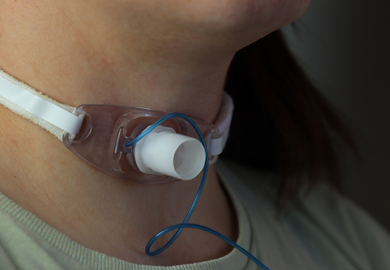 Tracheostomy tube in neck